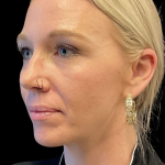 Sculptra Before & After Patient #11581