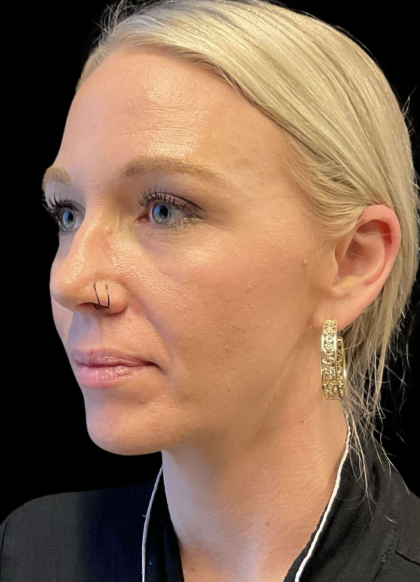 Sculptra Before & After Patient #11581