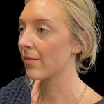 Chin Filler Before & After Patient #11586