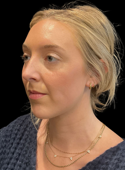 Chin Filler Before & After Patient #11586