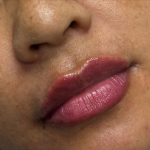 Lip Filler Before & After Patient #11585