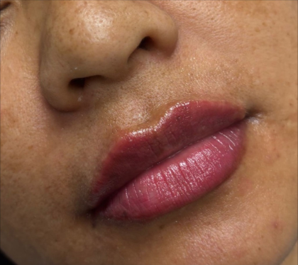 Lip Filler Before & After Patient #11585