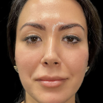 Cheek Filler Before & After Patient #11580