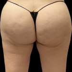 Brazilian Butt Lift Before & After Patient #11596