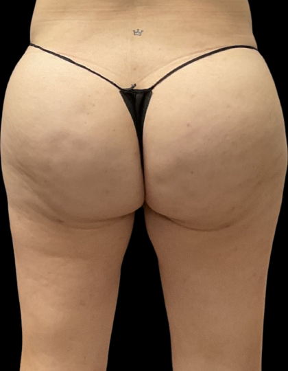 Brazilian Butt Lift Before & After Patient #11596