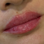 Lip Filler Before & After Patient #11576