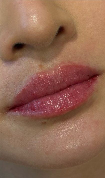 Lip Filler Before & After Patient #11576