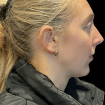 Chin Filler Before & After Patient #11586