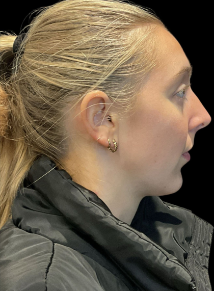 Chin Filler Before & After Patient #11586