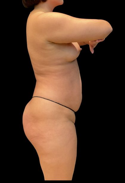 Brazilian Butt Lift Before & After Patient #11541