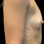 Breast Augmentation Before & After Patient #11593