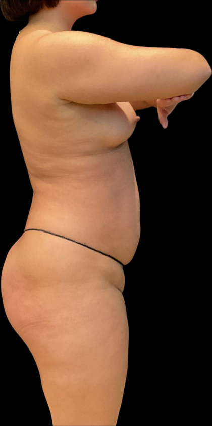 Brazilian Butt Lift Before & After Patient #11591