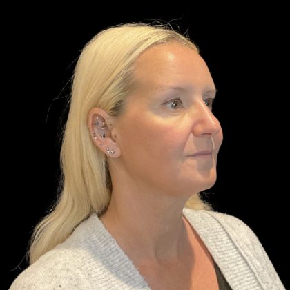 AVAVA Laser Before & After Patient #11821