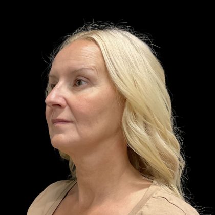 AVAVA Laser Before & After Patient #11821