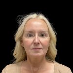 AVAVA Laser Before & After Patient #11821