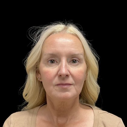 AVAVA Laser Before & After Patient #11821