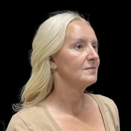 AVAVA Laser Before & After Patient #11821