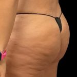Auto Buttock Augmentation Before & After Patient #11941