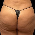 Auto Buttock Augmentation Before & After Patient #11941