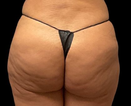 Auto Buttock Augmentation Before & After Patient #11941