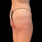 Auto Buttock Augmentation Before & After Patient #11958
