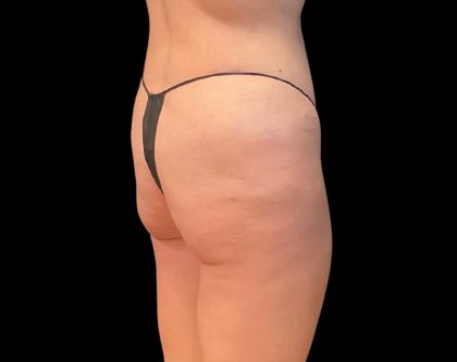 Auto Buttock Augmentation Before & After Patient #11958