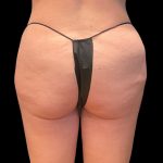 Auto Buttock Augmentation Before & After Patient #11958