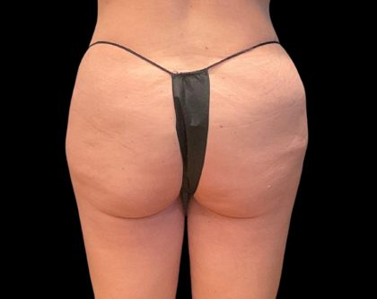 Auto Buttock Augmentation Before & After Patient #11958