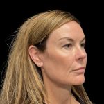AVAVA Laser Before & After Patient #11828