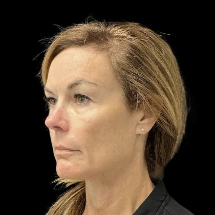 AVAVA Laser Before & After Patient #11828