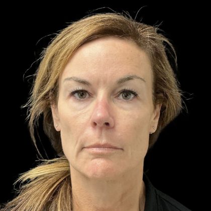 AVAVA Laser Before & After Patient #11828
