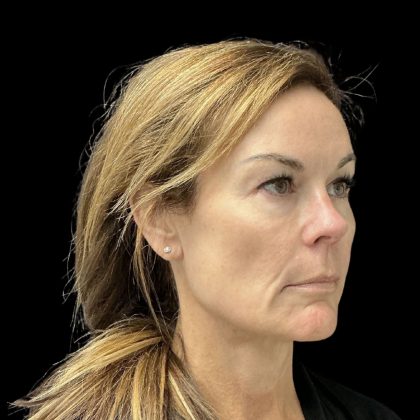 AVAVA Laser Before & After Patient #11828