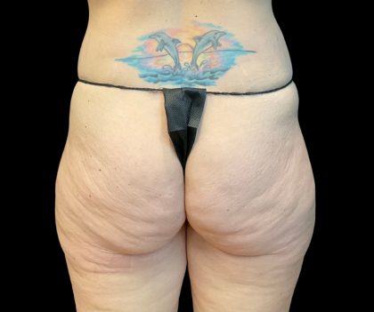 Auto Buttock Augmentation Before & After Patient #11950