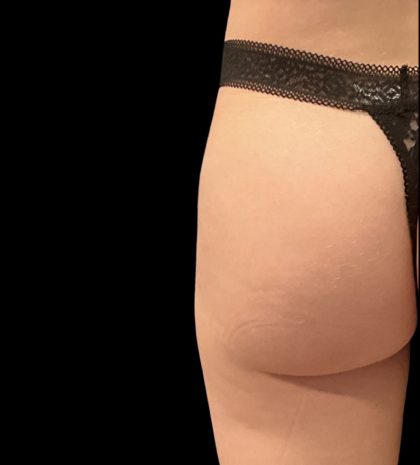Alloclae Before & After Patient #11900