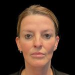 Sculptra Before & After Patient #11963