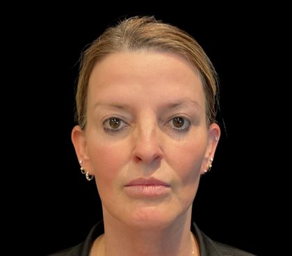Sculptra Before & After Patient #11963