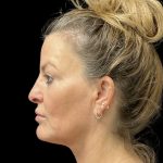 Sculptra Before & After Patient #11963