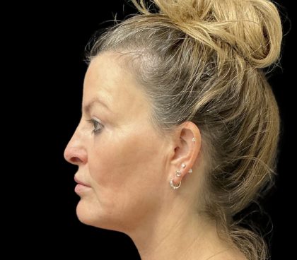 Sculptra Before & After Patient #11963