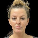Sculptra Before & After Patient #11963