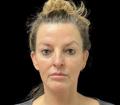 Sculptra Before & After Patient #11963