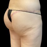 Auto Buttock Augmentation Before & After Patient #11953