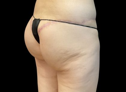 Auto Buttock Augmentation Before & After Patient #11953