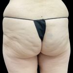Auto Buttock Augmentation Before & After Patient #11953