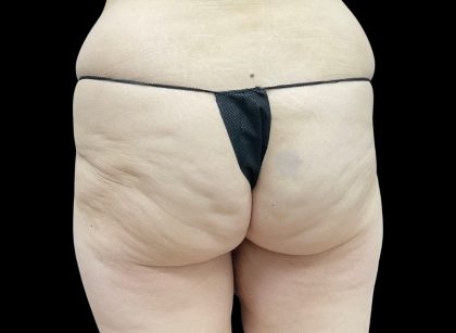 Auto Buttock Augmentation Before & After Patient #11953