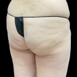 Auto Buttock Augmentation Before & After Patient #11953