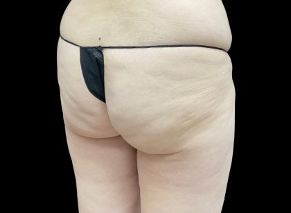 Auto Buttock Augmentation Before & After Patient #11953