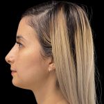 Liquid Rhinoplasty Before & After Patient #11930