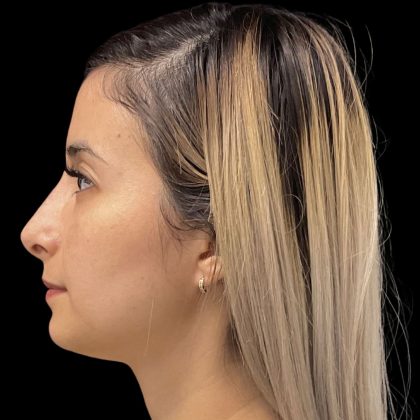 Liquid Rhinoplasty Before & After Patient #11930