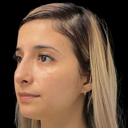 Liquid Rhinoplasty Before & After Patient #11930