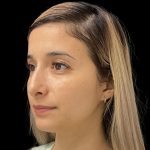 Liquid Rhinoplasty Before & After Patient #11930